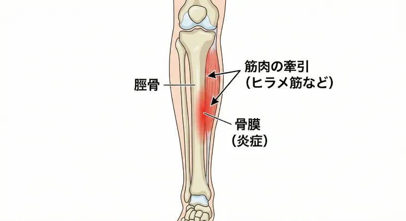 シンスプリントの詳しい図説