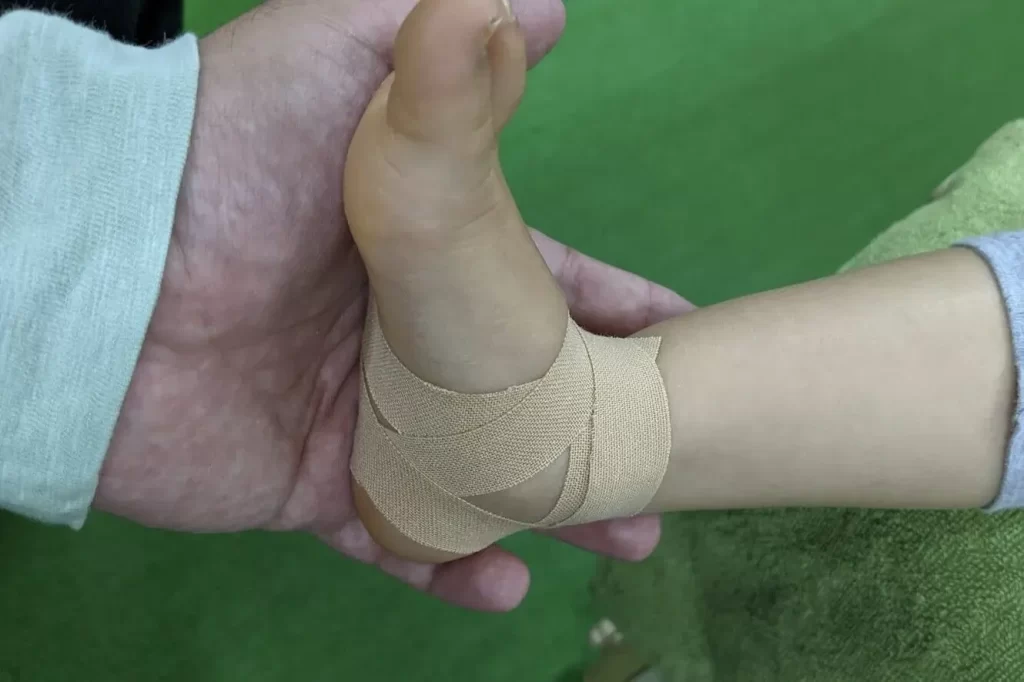 東海市でバレーボール選手に対する捻挫のテーピング