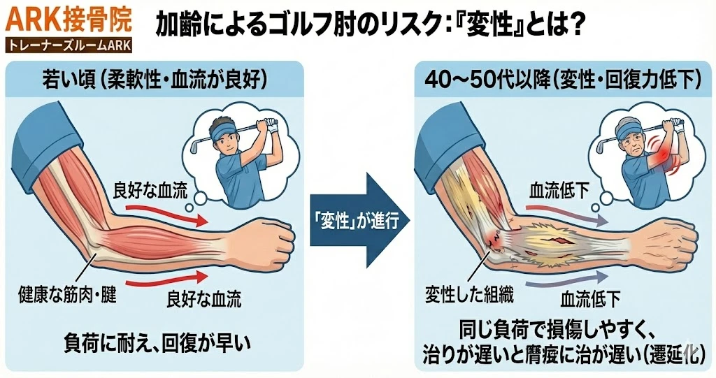 大府市でゴルフの肘の痛みは加齢が原因かもしれない図説