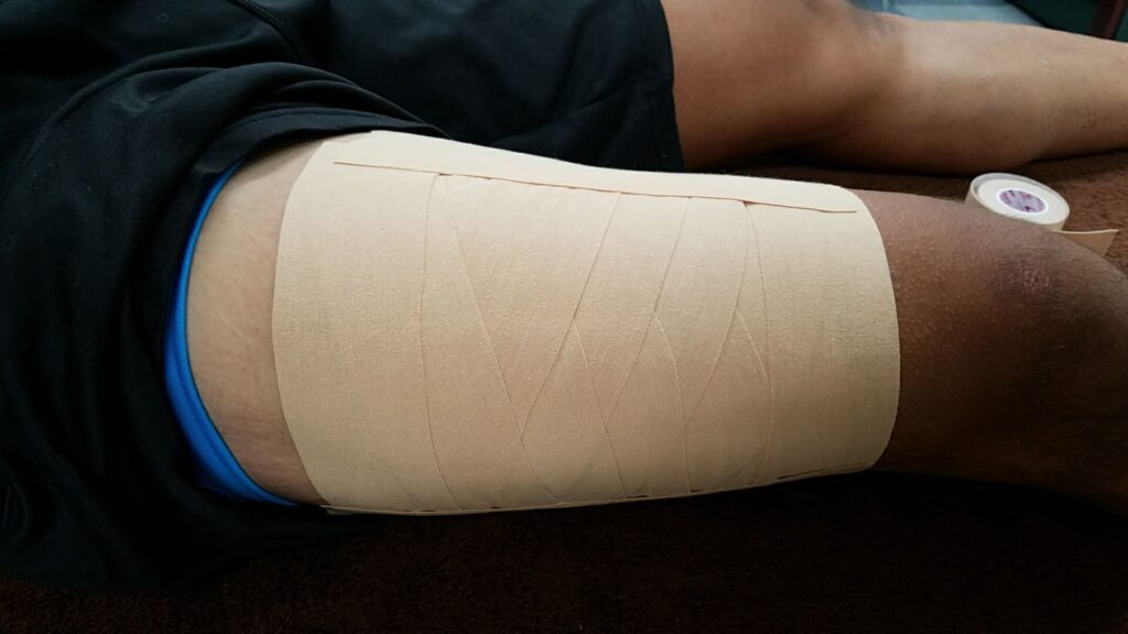 大腿部のARK接骨院によるテーピング治療。