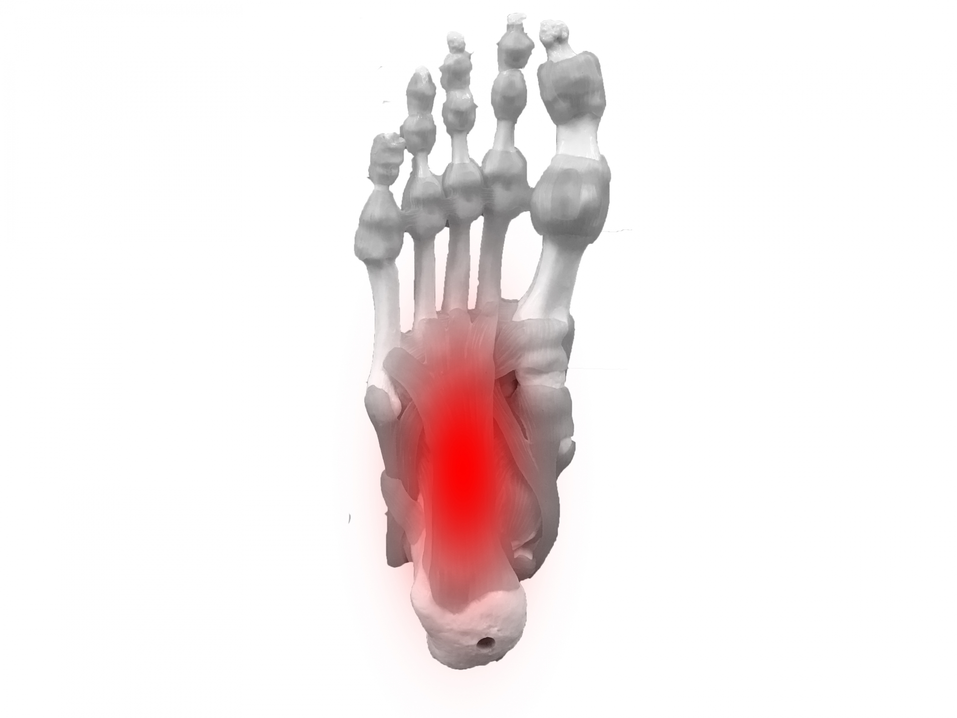 東海市ARK接骨院での足底筋膜炎解説の図