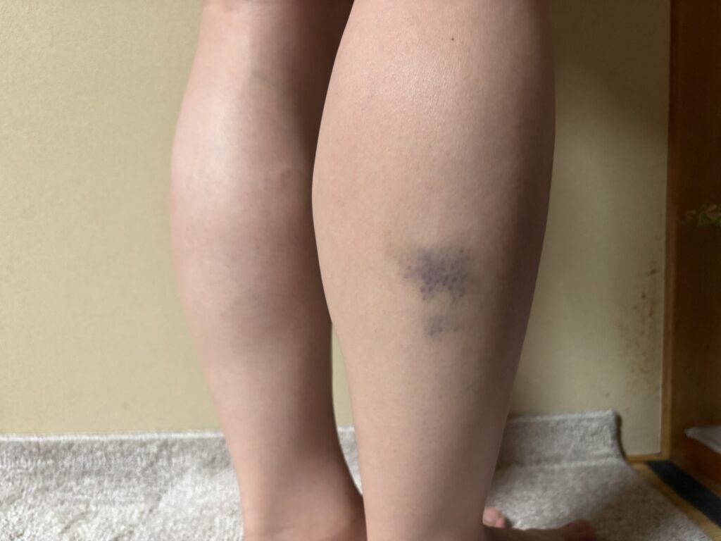 東海市で打撲のため内出血(青あざ)が出来てしまったふくらはぎ