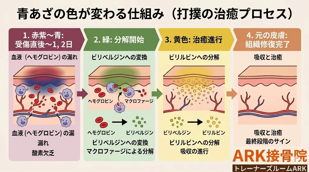 東海市で打撲の痛み解説