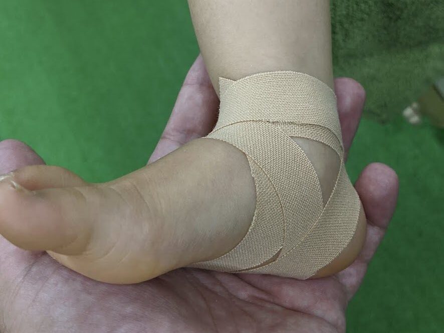 足首の捻挫でテーピングを巻くARK接骨院