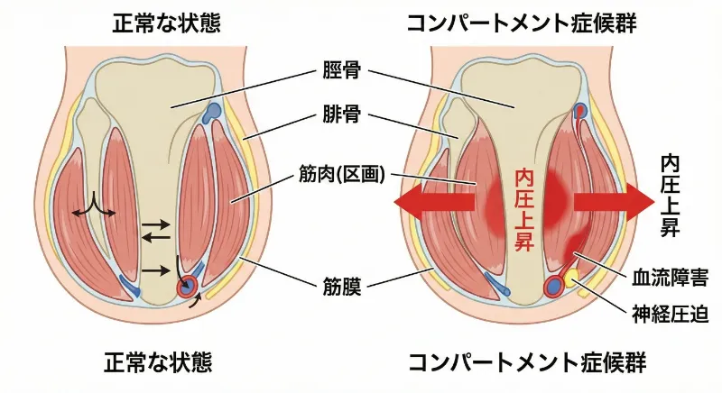 知多市で打撲の後遺症コンパートメント症候群を説明する図