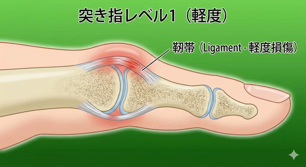 打撲、捻挫、挫傷、東海市での突き指解説図