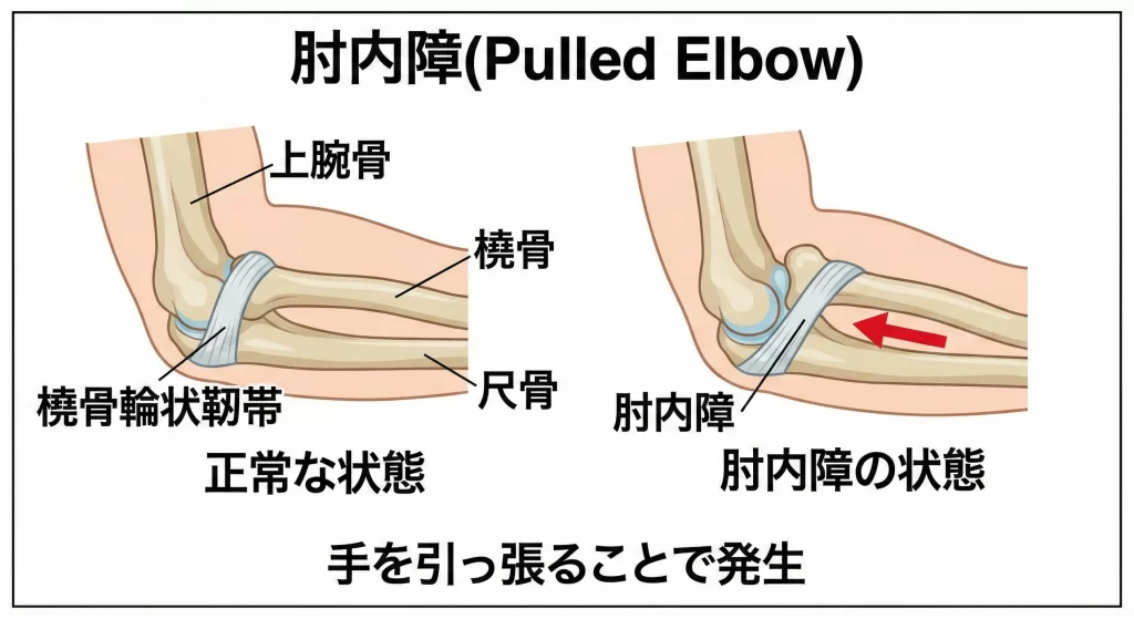 東海市のARK接骨院による肘内障の解説図