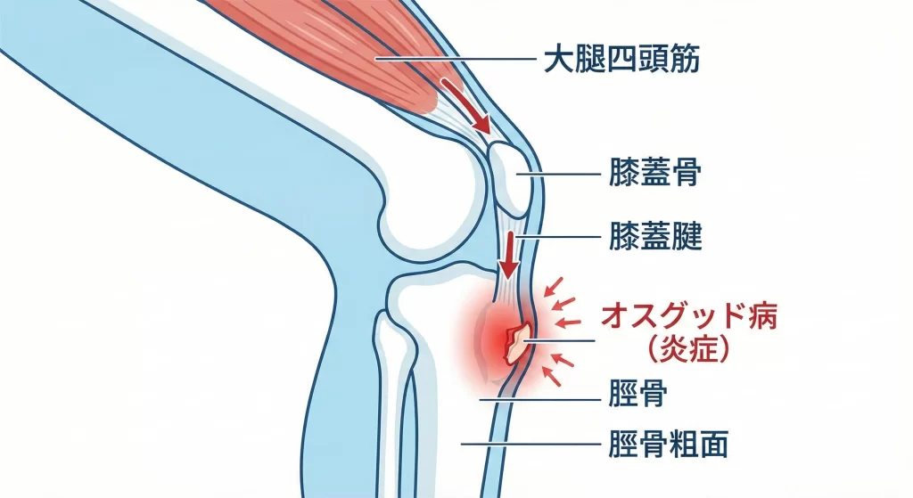 半田市でオスグッドの解説をするARK接骨院