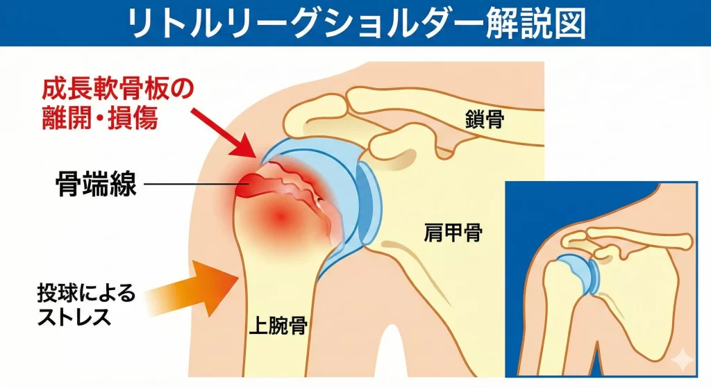 大府市で少年野球選手に起こるリトルリーグショルダーの解説図