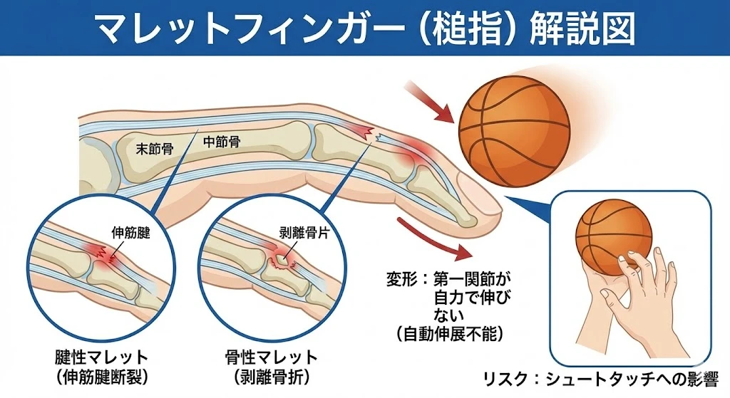 東海市で突き指痛みが出るマレットフィンガー