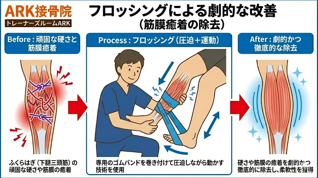 大府市でランニングの足の痛みに対するフロッシング