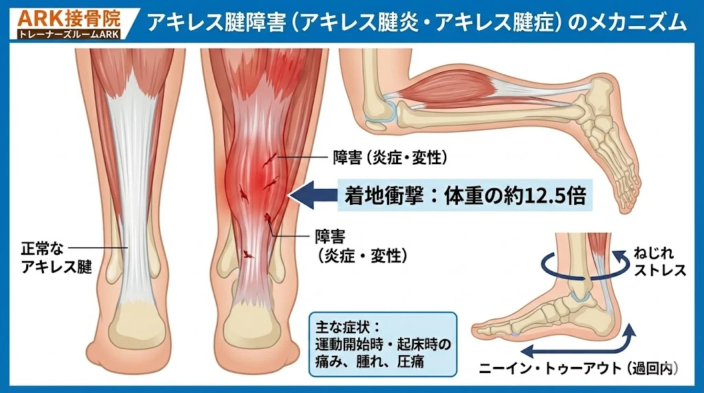 知多市でアキレス腱の痛みがある陸上選手の解説図