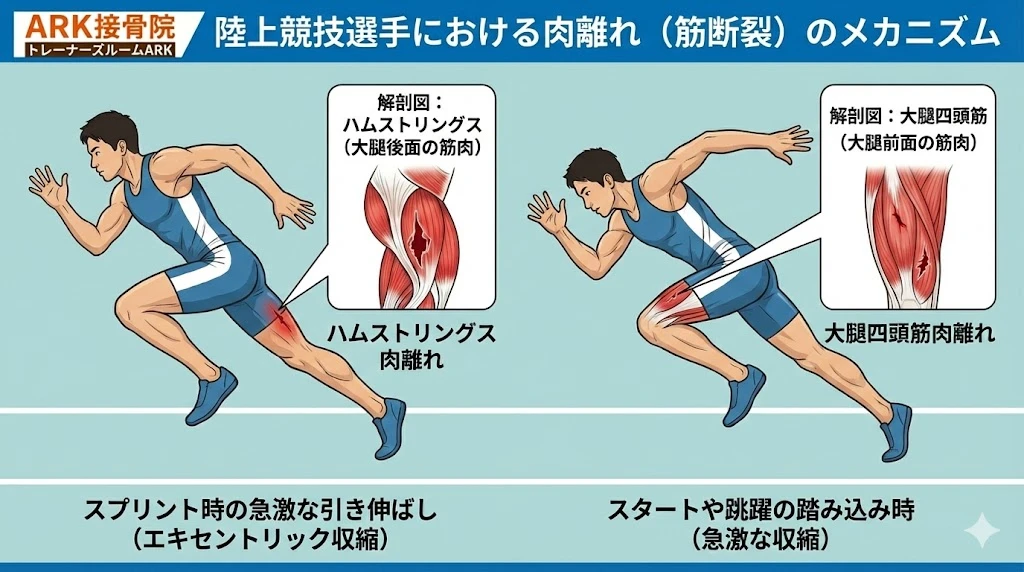 大府市で短距離で痛みの強い肉離れをするプロセス解説図
