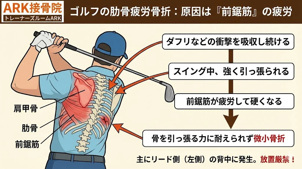 ゴルフスイングによる左背中の肋骨疲労骨折のイメージ