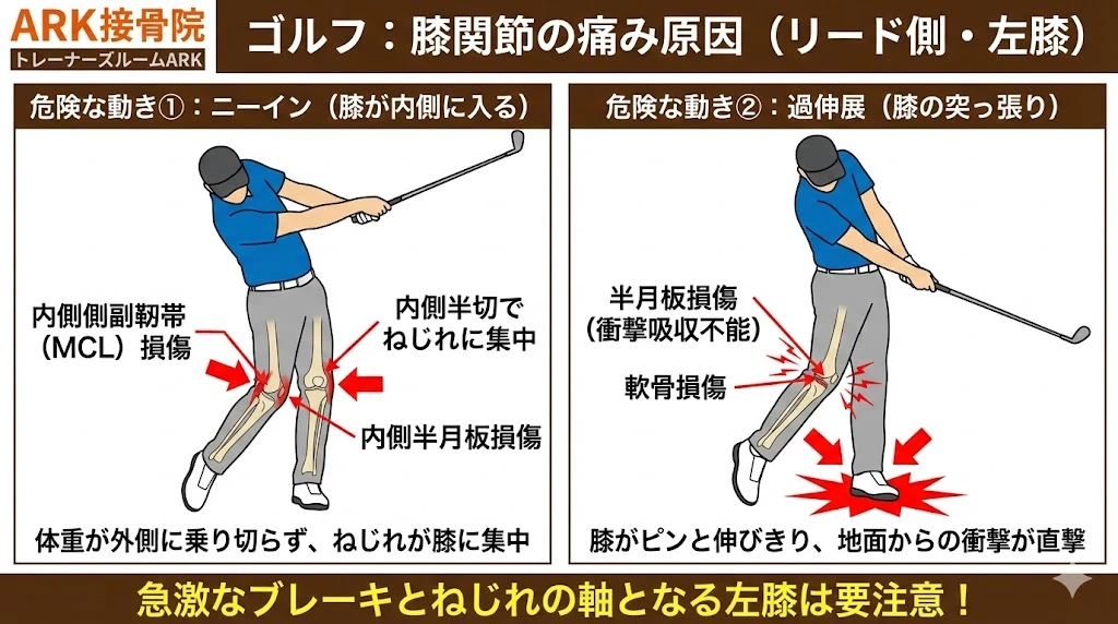 ゴルフのニーインによる膝関節への負担と痛みのメカニズム