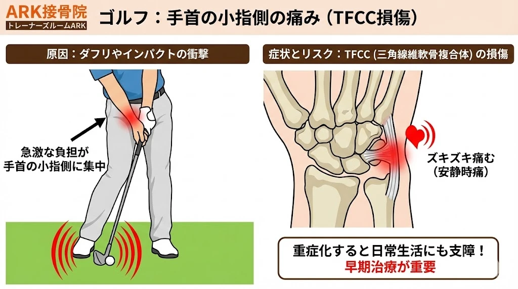 大府市でゴルフのプレー中手首が痛いTFCC損傷