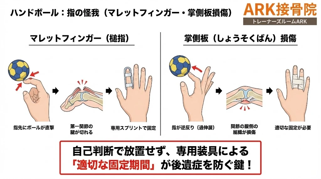 知多市でハンドボールでの指の痛み、突き指の解説図