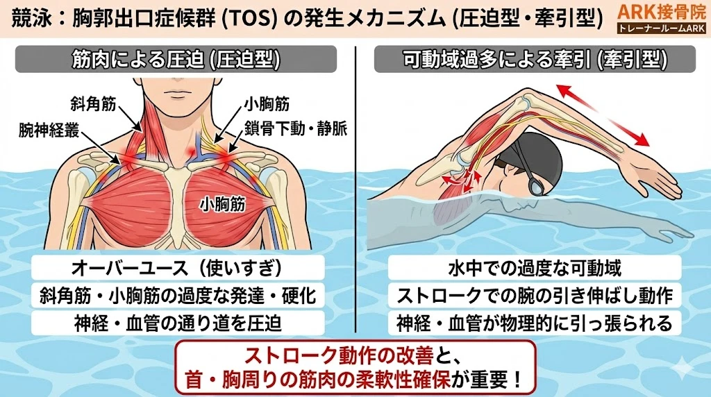 大府市で水泳による腕のしびれ、胸郭出口症候群の図説