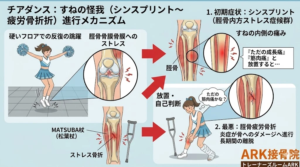 大府市でチアダンスでのスネの痛み、シンスプリントの解説
