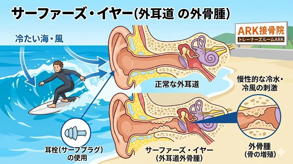 知多市でサーファーの悩みの解説図
