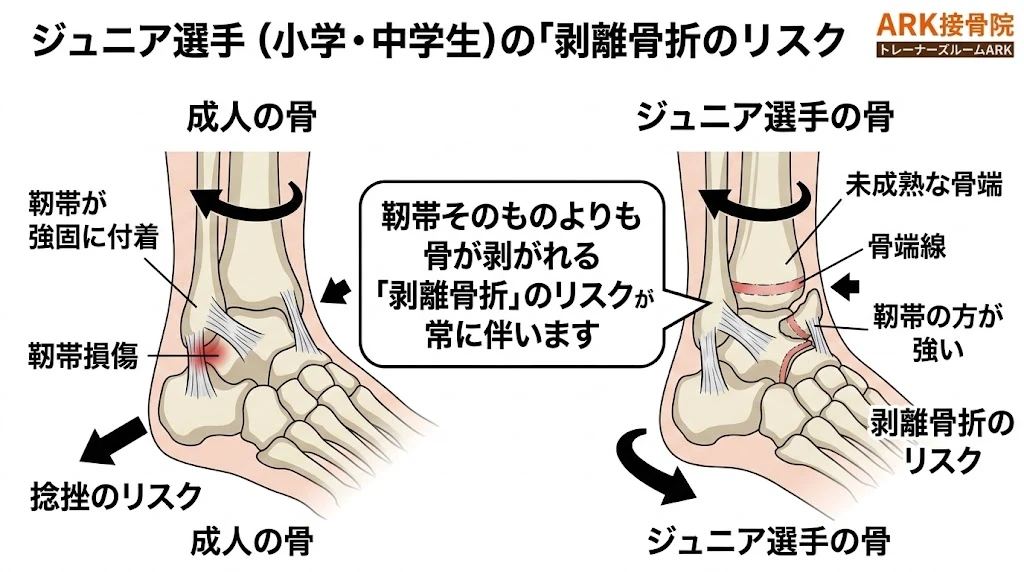 大府市で野球での足首の痛み、捻挫による骨端線離開解説図