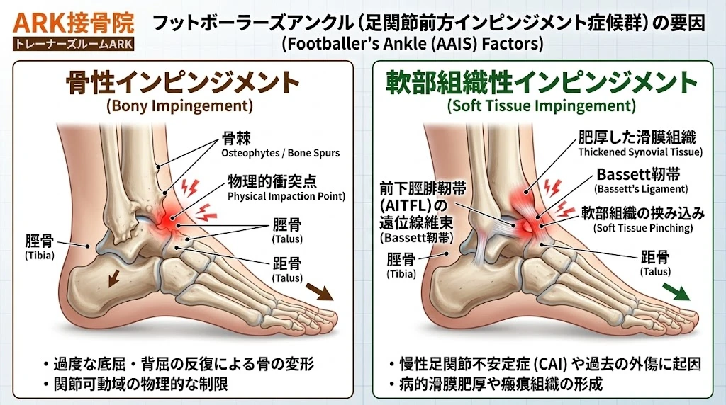 知多市で足首の痛みフットボーラーズアンクルの解説図