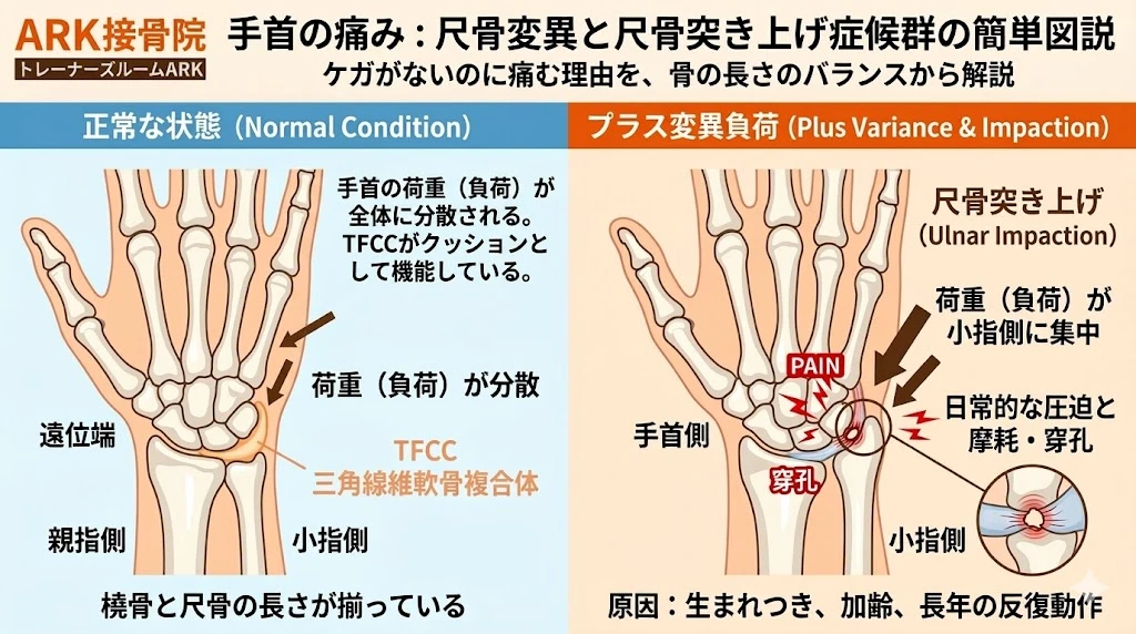 東海市でTFCC損傷で手首の小指側が痛い