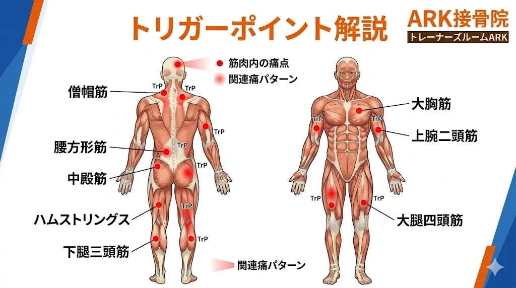 大府市で腰痛の原因、トリガーポイント形成の図