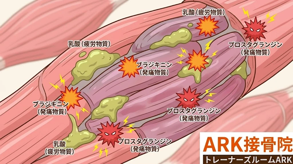東海市でぎっくり腰による疲労物質、発痛物質による組織の鬱滞