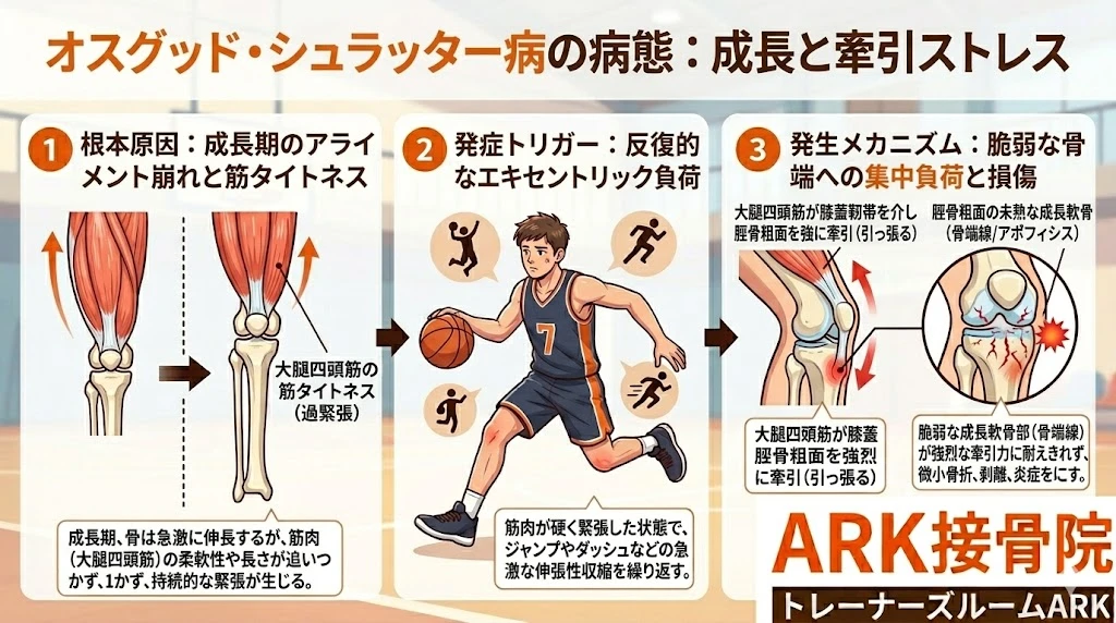 知多市のジュニアバスケ選手に多いオスグッドのメカニズム