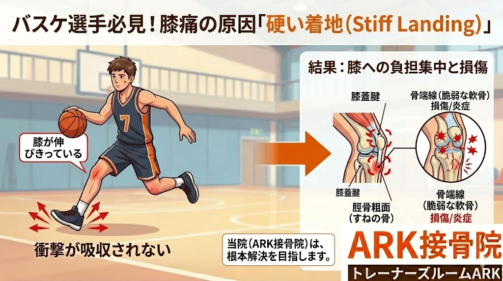 知多市でバスケットボールにおける膝の痛みはオスグッドかジャンパー膝かもしれない