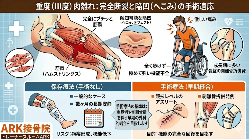 東海市で肉離れで歩けないときの対処法