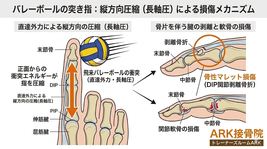 常滑市でバレーボールによる突き指の痛み