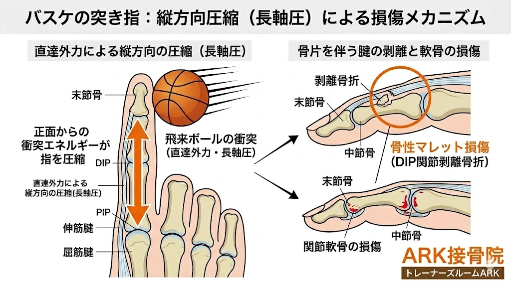 大府市でバスケットボールでの突き指による指の痛み