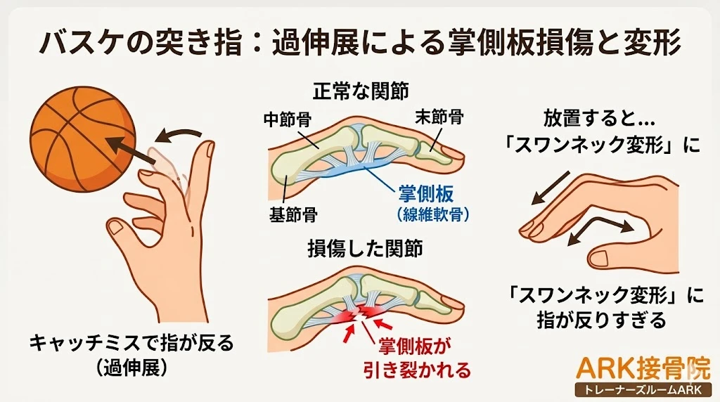 知多市でバスケットボールによる指の痛みは突き指
