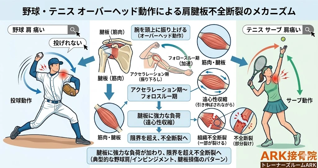 知多市で腱板損傷による肩の痛み