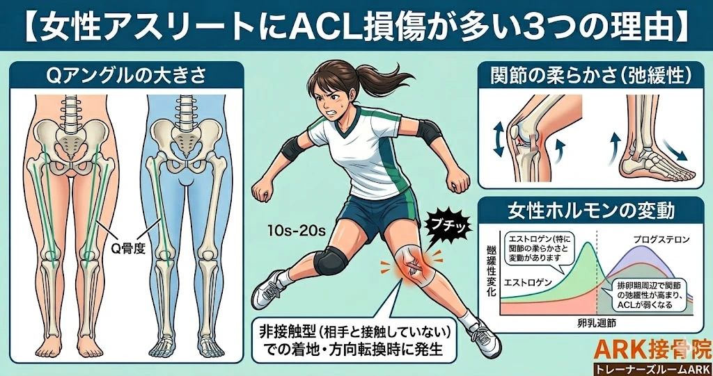 東海市で女性アスリートとACL損傷