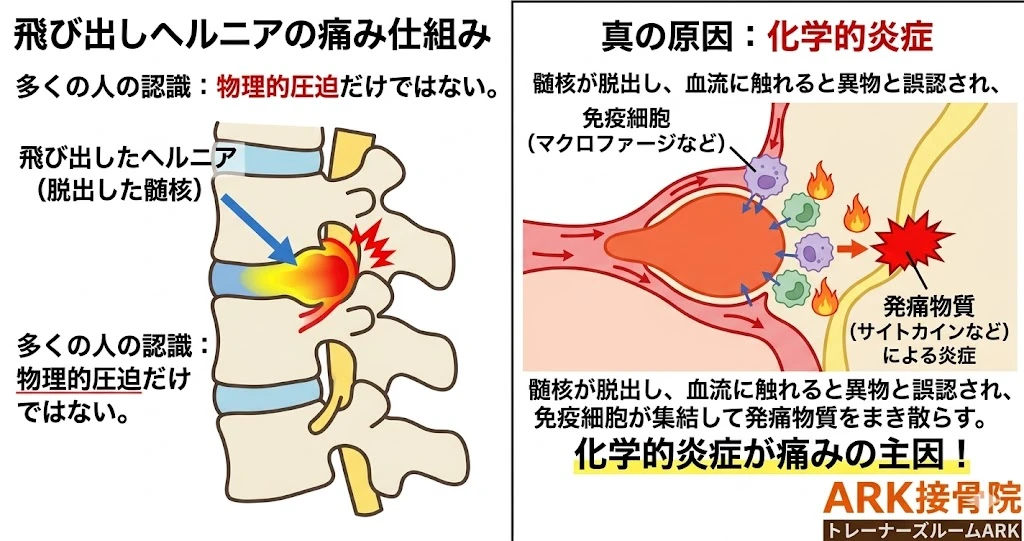 大府市で首が痛いのは頚椎椎間板ヘルニアかもしれない