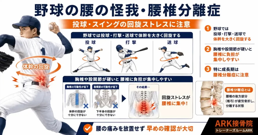 野球での腰の怪我、腰椎分離症の詳しい解説