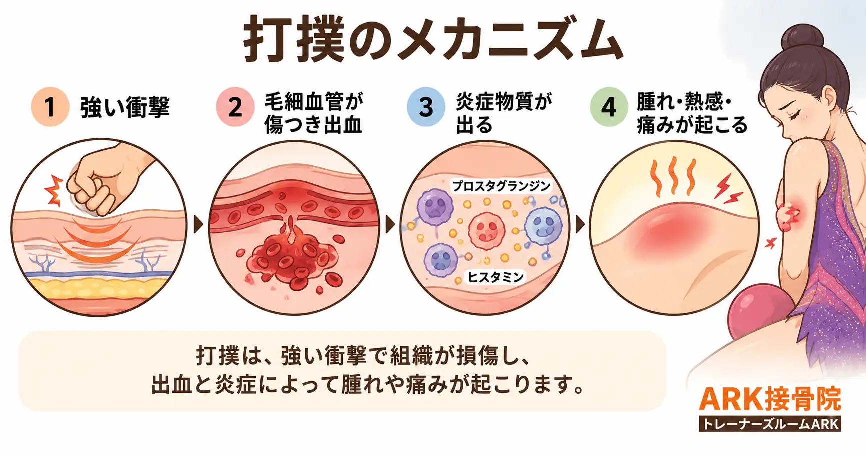 新体操における打撲のメカニズム