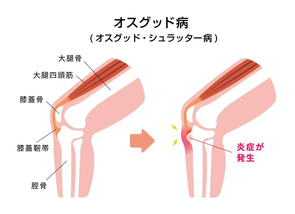 オスグッド病、オスグット病についての解説