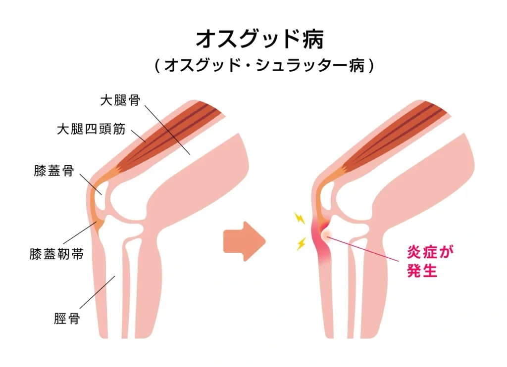 サッカーでもよく起こるオスグッドと膝の痛み